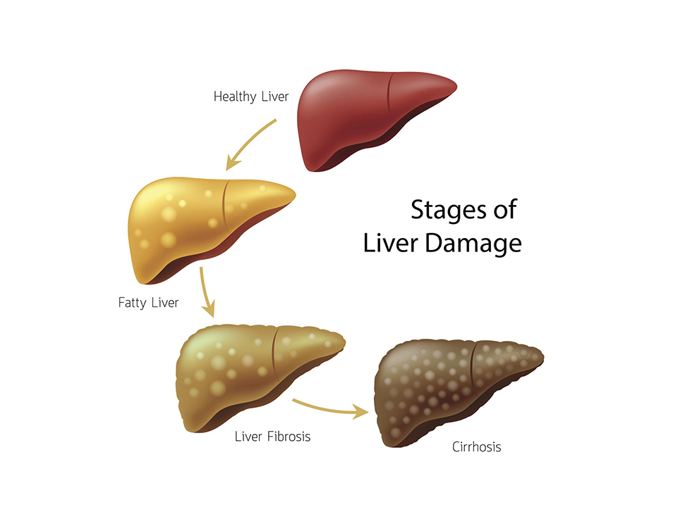 Tiredness, Weight Loss, And Itching Are Signs Of This Dangerous Liver